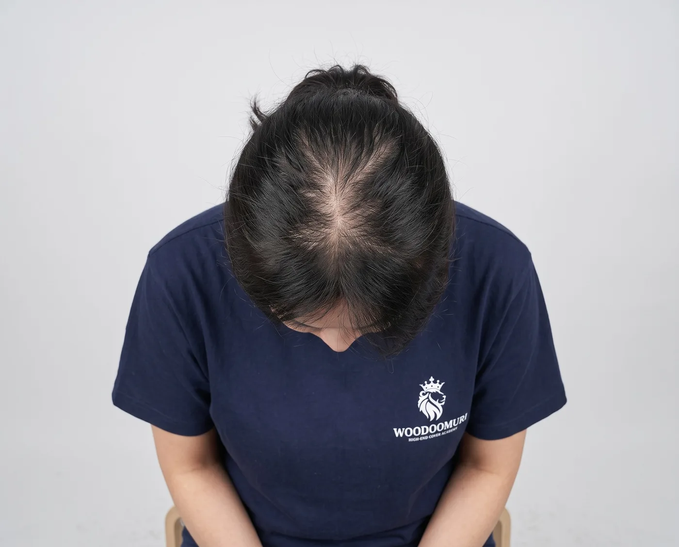 여성 가르마 — 시술 전 두피 상태