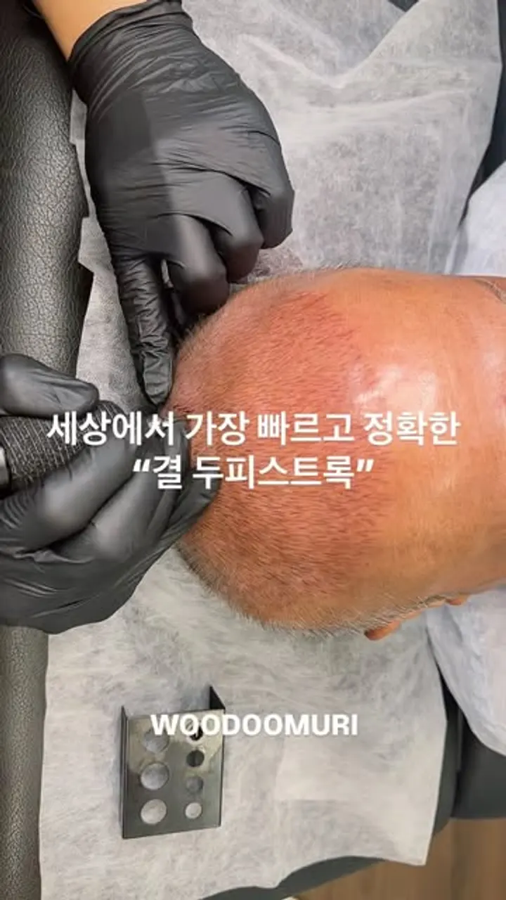 세상에서 가장 빠르고 정확한 결 두피스트록