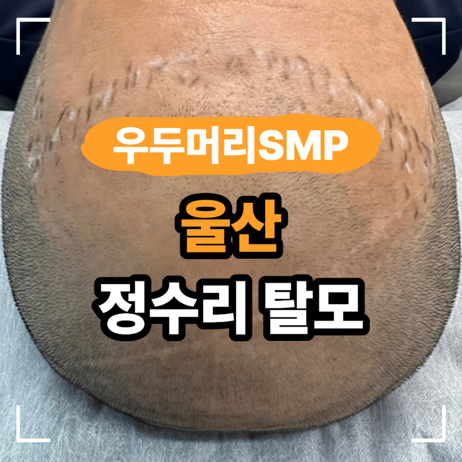 울산 정수리 탈모 두피 문신 실력이 중요한 이유