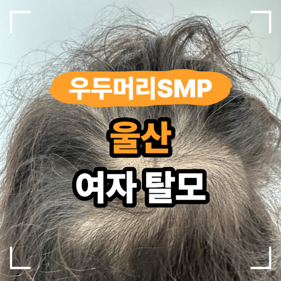 울산 여자 탈모 두피문신 원장이 점 아닌 결 선택한 이유