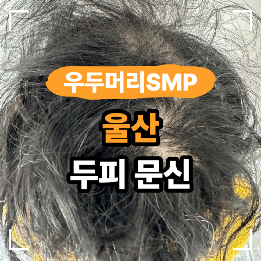 울산 SMP 두피 문신 유형별 다른 기법 기준