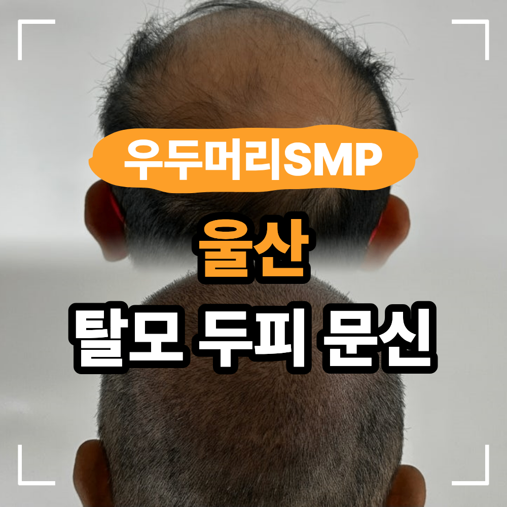 울산 SMP 두피 문신 남자 탈모 커버 방법