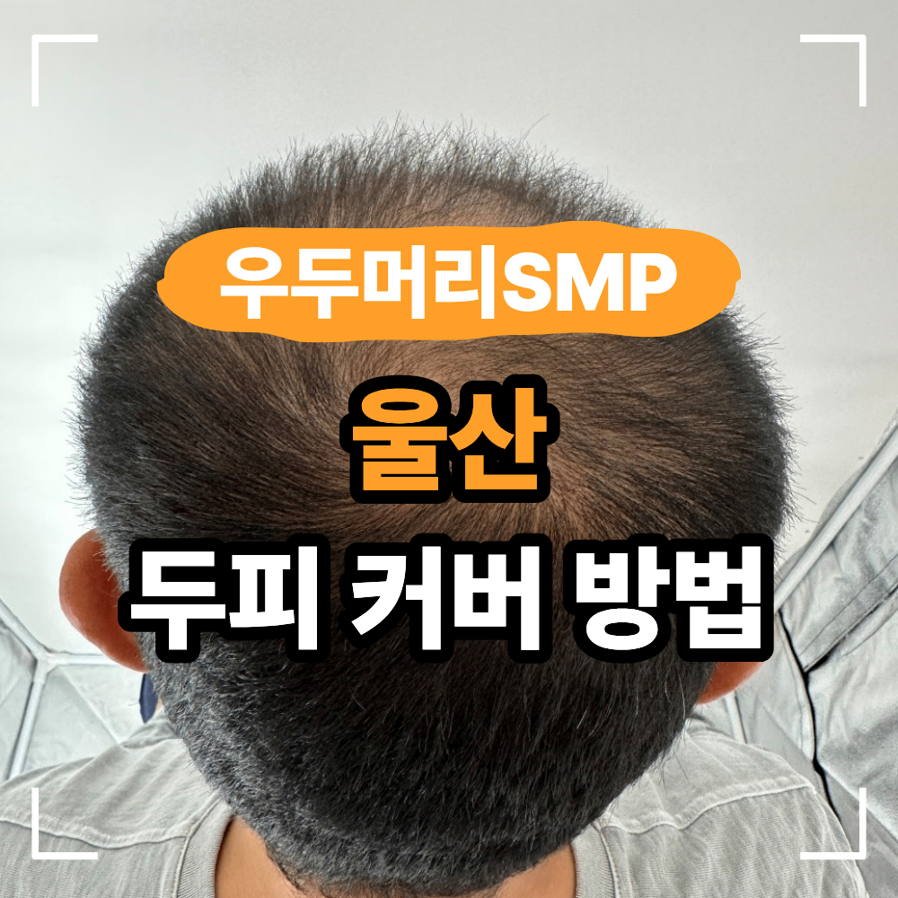 울산 SMP 두피 문신 비침 커버 방법