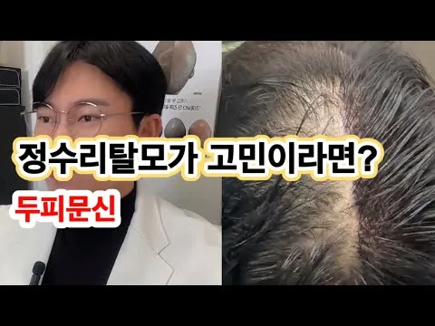 정수리 탈모가 고민이세요? (울산 우두머리 SMP 정수리 탈모 미용)