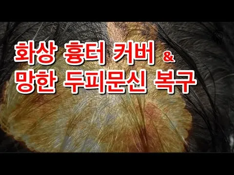 화상 흉터도 두피문신으로 커버 가능할까요? (울산 우두머리 SMP LSMP 흉터커버 화상흉터 탈모치료 탈모상담)