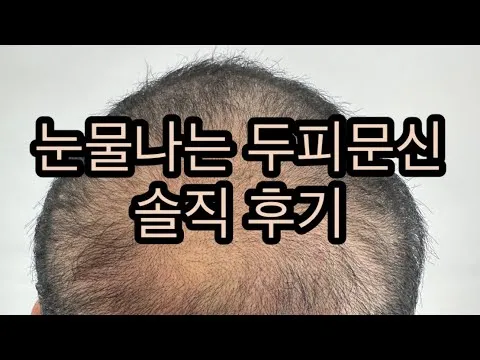 [두피문신] 눈물나는 두피문신 솔직 후기 (SMP 내돈내산 후기 탈모 사연)